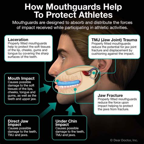 mouth guard